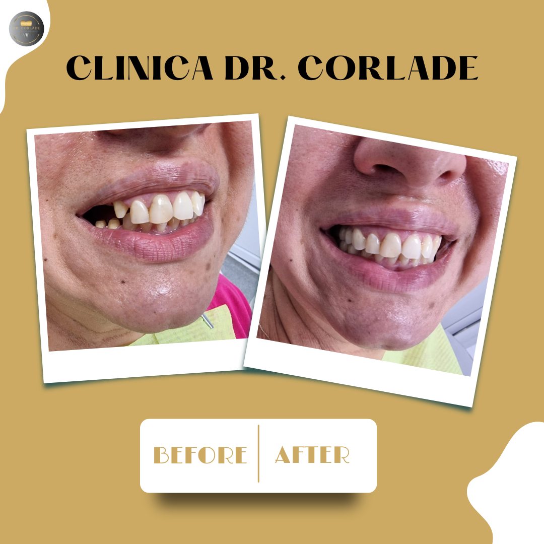 Pacient înainte de reabilitarea protetică — dinți deteriorați