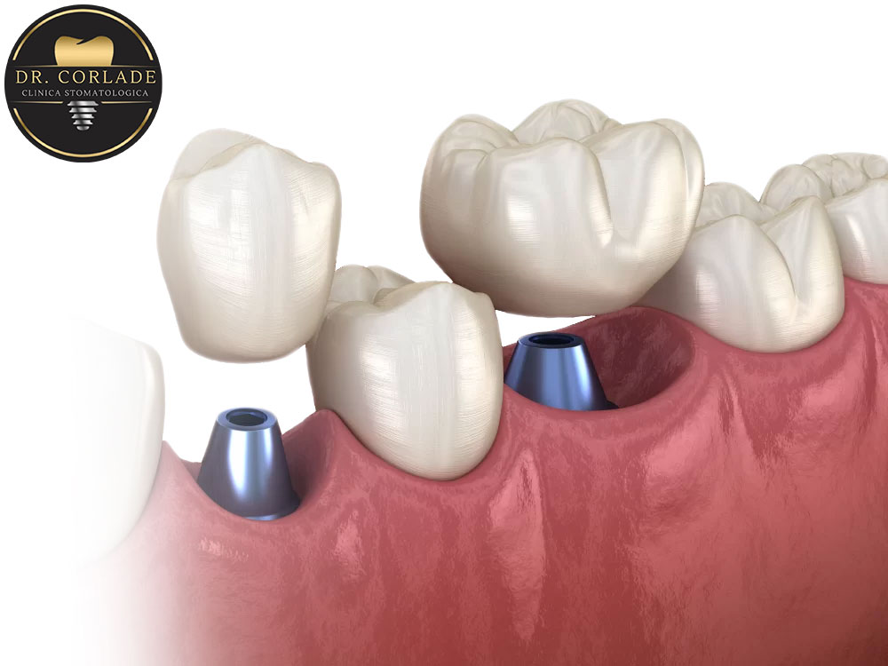 Prețuri Implantologie și Chirurgie — Clinica Dr. Corlade Bacău