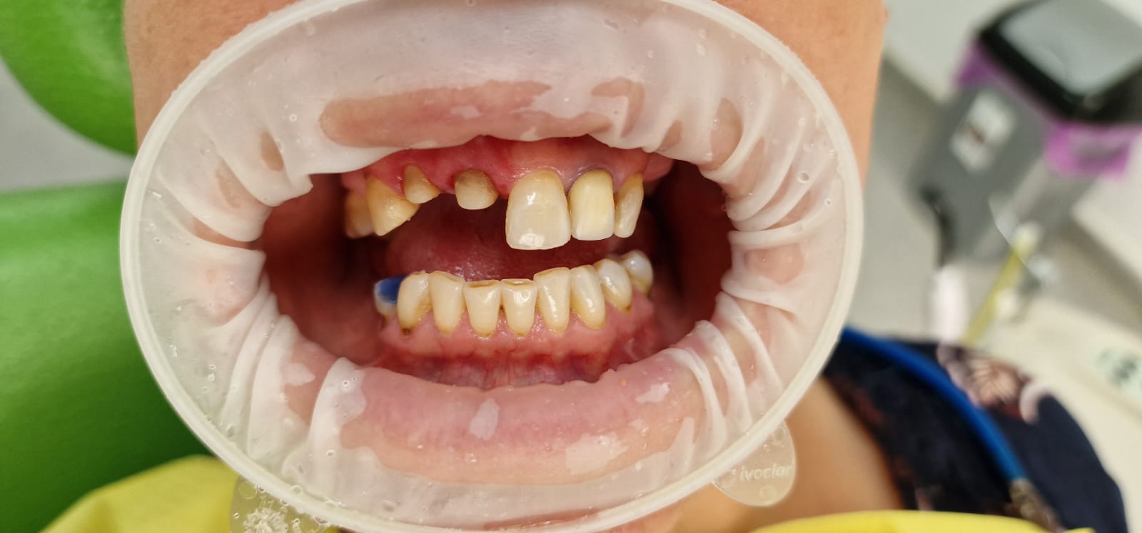 Pacient după reabilitarea protetică cu coroane metalo-ceramice