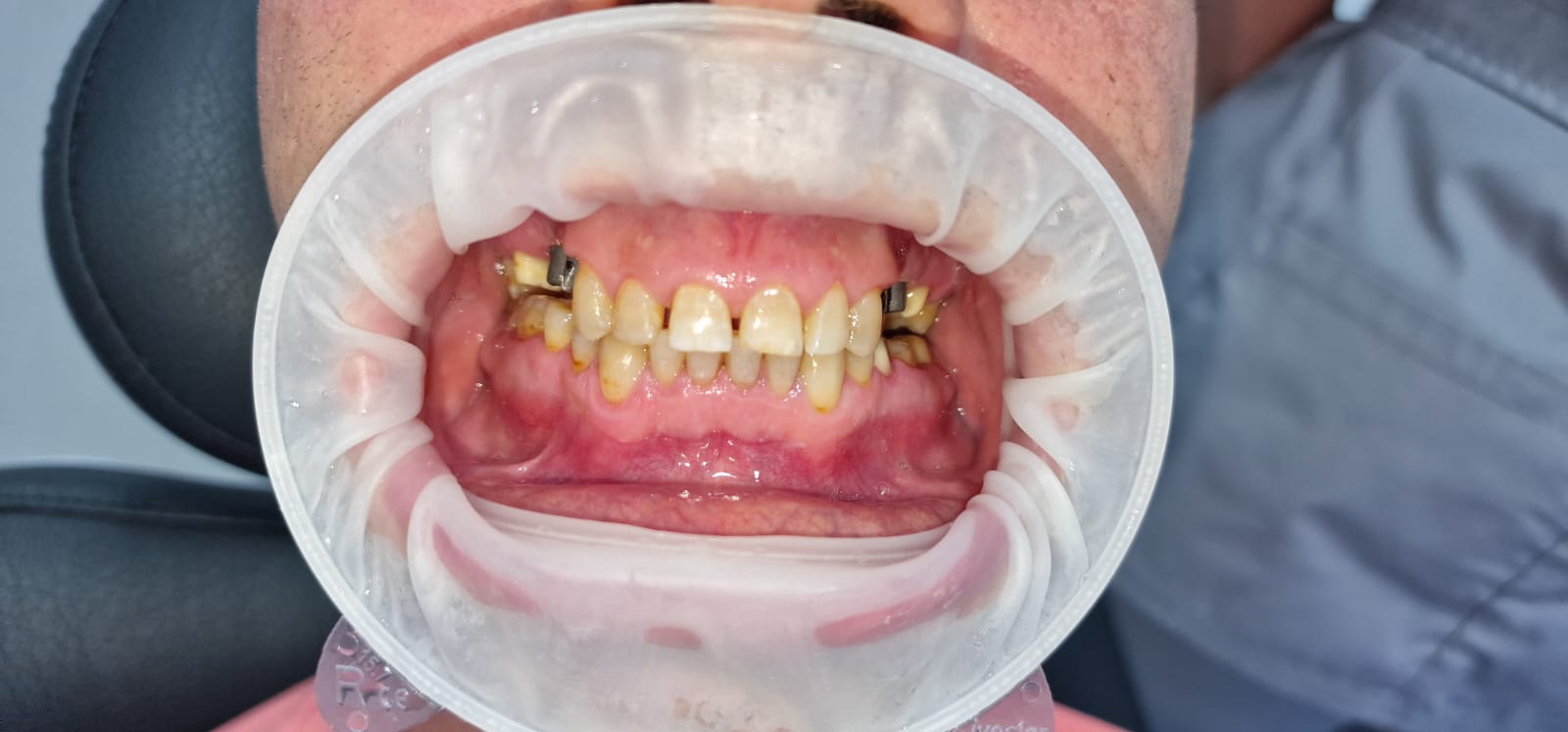 Implant unitar cu coroană zirconiu — după tratament la Clinica Dr. Corlade Bacău